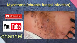 Mycetoma chronic fungal infection [upl. by Asilla]