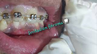 Oral benign asymptomatic prolonged irritation fibroma caused by cheek biting rubbing from teeth [upl. by Noryak]