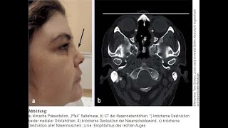 Orbitabodenbeteiligung bei Granulomatose mit Polyangiitis [upl. by Meeks]