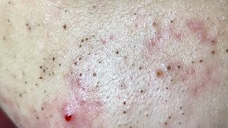 Acne Treatment Huong Da Nang The video has been lost for a long time Remove Blackheads [upl. by Sarena53]