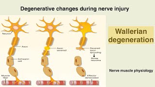 Wallerian degeneration  Nerve injury  peripheral nerve damage [upl. by Allac]