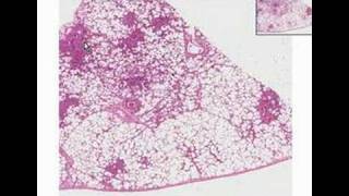 Histopathology LungBronchopneumonia [upl. by Hardej]