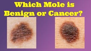 How To Check Your Mole For Skin Cancer  Benign vs Melanoma [upl. by Isaac58]