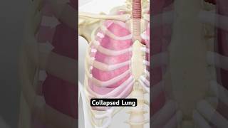 Collapsed lung explained 3D Animation [upl. by Hermes]