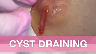 Cyst Draining  Avert your eyes if youre easy queasy [upl. by Latoya]