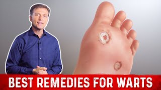 4 Best Wart Removal Remedies – Dr Berg on Wart Treatment at Home [upl. by Hildagarde]