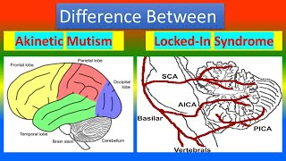 Difference between Akinetic Mutism and Lockin Syndrome [upl. by Nnaylloh]