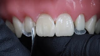 Peg Laterals Restorations with Rhodri Thomas BDS [upl. by Patsis]