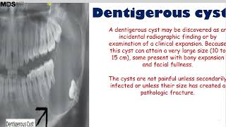 5 1 Dentigerous Cyst [upl. by Alleuqahs]