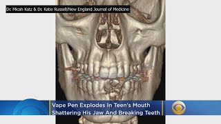 Vape Pen Explodes In Teens Mouth Shattering His Jaw [upl. by Leshia]