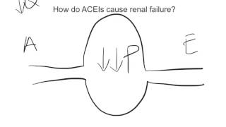 ACEIRenal Failure [upl. by Aicella449]