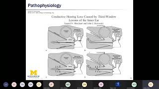 Superior Semicircular Canal Dehiscence  Dr Emily Stucken MD  University of Michigan [upl. by Ruford742]