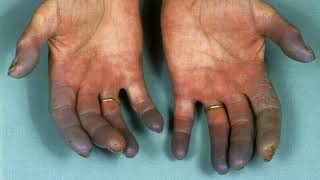 Difference Between Raynaud’s Disease and Buerger’s Disease [upl. by Kinom527]