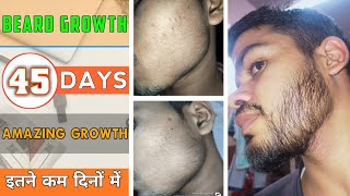 BEARD GROWTH  इतने कम दिनो में Amazing growth □ 45 days  Beard growth transformation 🙌 [upl. by Ferro]