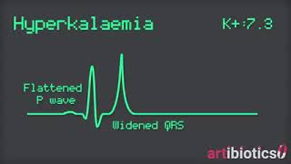 diagnosis of Hyperkalemia in ECG [upl. by Aisercal]