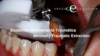 Exodontia Minimamente Traumática  Minimally Traumatic Extraction [upl. by Meil]