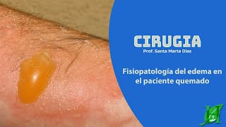 Fisiopatología del edema en el paciente quemado [upl. by Ordnajela]