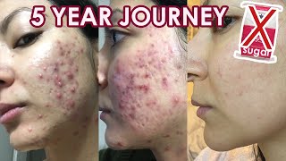 How I FINALLY got rid of my acne NATURALLY  no accutane [upl. by Sup]