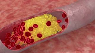 DISLIPIDEMIA ¿Qué es [upl. by Volin]