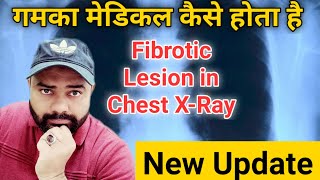 Fibrotic lesion in chest xray  Gamca medical kaise hota hai [upl. by Idissac261]