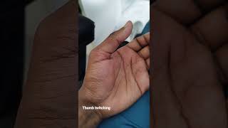 thumb twitching fasciculation [upl. by Pius347]