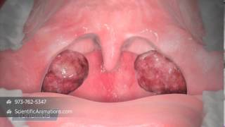 3D Medical Illustration of Tonsils  Tonsillitis Animation  ENT Animation [upl. by Leiruh]