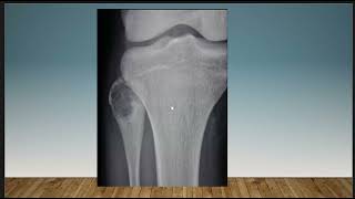 Short Case Discussion  Chondroblastoma  fibula [upl. by Schach]