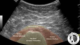 Gluteal Tendon PRP [upl. by Shawnee]