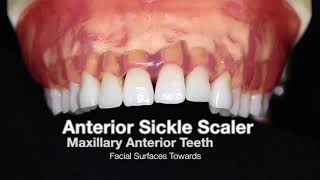 Anterior Sickle Scaler Instrumentation Technique [upl. by Hallock]