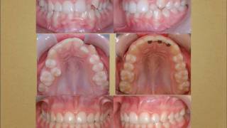 Cas traités en orthodontie orthodontistes Lemaymov [upl. by Ayerim]