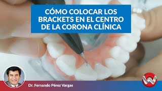 Cómo colocar los brackets en el centro de la corona clínica [upl. by Neellok371]