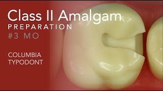 Class II Amalgam Preparation 3 MO [upl. by Samoht]