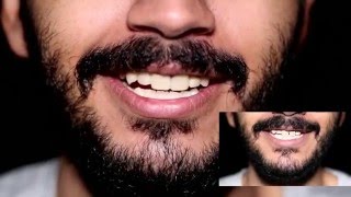 DSD  Digital Smile Design تصميم الابتسامة الرقمي [upl. by Uzzial]