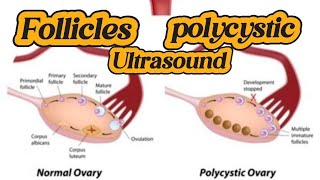 Ovarian Follicles  Adnexal Cyst with Septation  Hemorrhagic Cyst on Ultrasound [upl. by Chenee44]