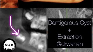 Dentigerous Cyst Removal with Extraction of Involved Impacted Molar drwahan [upl. by Nairda]