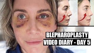 Blepharoplasty Video Diary  Day 5 After Surgery 4 of 15 [upl. by Emmit843]