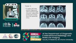 Emergency epistaxis embolization after nasal and oral surgical interventions traumatic epistaxis [upl. by Burford83]