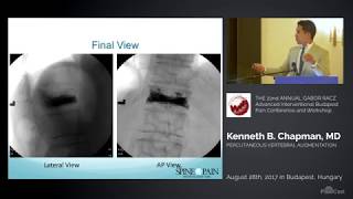 Vertebroplasty and Kyphoplasty Lecture Dr Chapman [upl. by Narud]