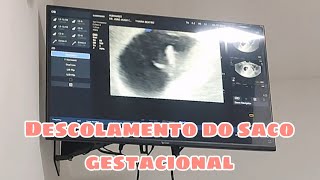 Descolamento do saco gestacional primeiras ecografias do baby [upl. by Sunda841]