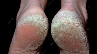 Palmoplantar Psoriasis Dos amp Donts  உள்ளங்கால் சொரியாசிஸ் சவால்  Dr Selvin [upl. by Nylirac]