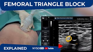 UltrasoundGuided Femoral Triangle Nerve Block  NYSORAs Regional Anesthesia Clinical cases [upl. by Anikat]