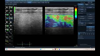 IQ 305 LIVER ULTRASOUND ECHOPAC ANALYSIS HEPATOMA ELASTOGRAPHY [upl. by Eynaffit]