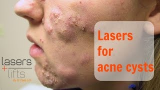 Treating acne cysts [upl. by Acsehcnarf]