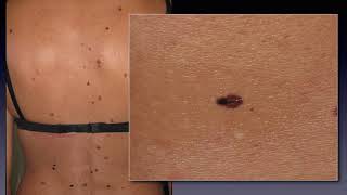 Dermoscopy for skin cancer screening  Dr Claudio Conforti [upl. by Neerahs]