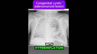 Congenital cystic adenomatoid malformation CCAM [upl. by Alfi]