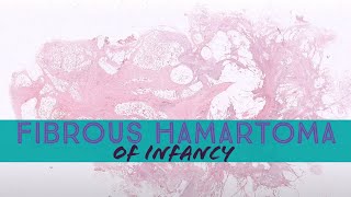 Fibrous hamartoma of infancy dermpath dermatology dermatopathology soft tissue pathology [upl. by Atsed558]