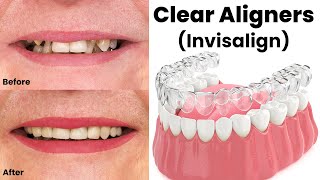 Clear Aligners Invisalign Price in Pakistan  Invisible Braces  Guide By Dr Shahzad Mirza [upl. by Ulda]