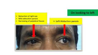 Duanes Retraction Syndrome [upl. by Allerym]