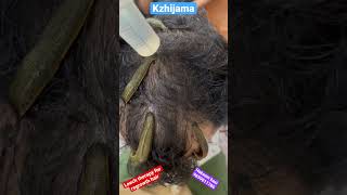 Which therapy is best for hair fall leechtherapy leech haircare hairfall hair hairstyle dr [upl. by Al108]