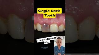 How to Fix a Discoloured Tooth Options Explained dentallan dentist shorts [upl. by Beedon]